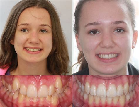 1 month braces transformation|Braces Before And After: A Transformation Gallery.